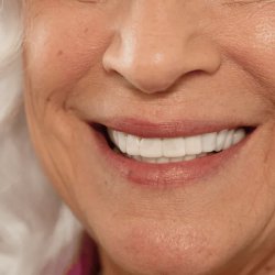 لمینت دندان دو فک مدل TruSmile (اورجینال)